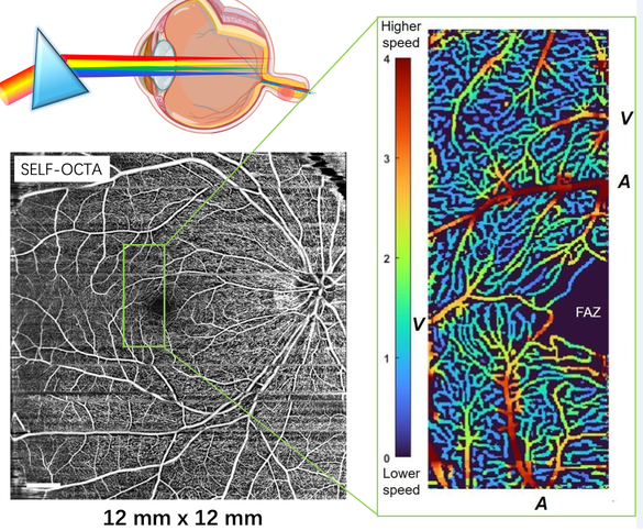 OptoElectronAdv's tweet photo. #OEA_highlight Spectrally extended line field optical coherence tomography angiography https://t.co/BvhBEaIYv8 by Prof. #Linbo_Liu @NTUsg #optical_coherence_tomography #OCT #angiography #retina #diabetic_retinopathy #ophthalmology https://t.co/131ZGYkL1V