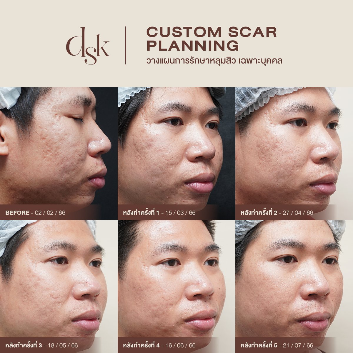 DSK Clinic คลินิกเลเซอร์ หลุมสิว ปรับรูปหน้า (@DSKclinic) / Posts / X
