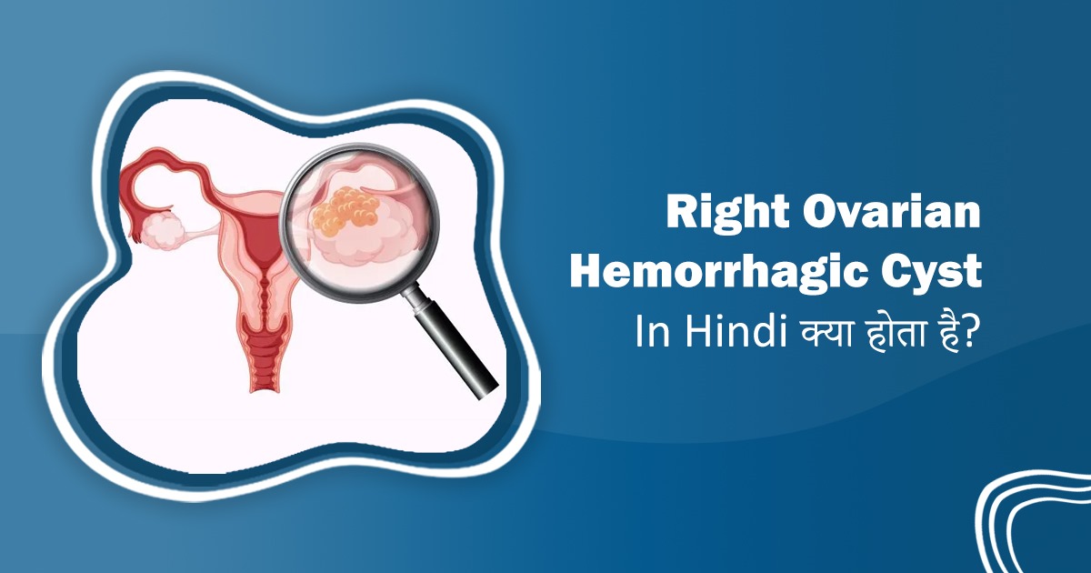 Dr. Rita Bakshi (IVF specialist) (@dr_ritabakshi) on Twitter photo What is a Right Ovarian Hemorrhagic Cyst?
Dr. Rita Bakshi explains symptoms, causes & treatment in this easy-to-understand Hindi blog.
🔗 drritabakshi.in/right-ovarian-…
#OvarianCyst #WomensHealth #DrRitaBakshi #HindiBlog #HealthAwareness #RisaaIVF What is a Right Ovarian Hemorrhagic Cyst?
Dr. Rita Bakshi explains symptoms, causes & treatment in this easy-to-understand Hindi blog.
🔗 drritabakshi.in/right-ovarian-…
#OvarianCyst #WomensHealth #DrRitaBakshi #HindiBlog #HealthAwareness #RisaaIVF