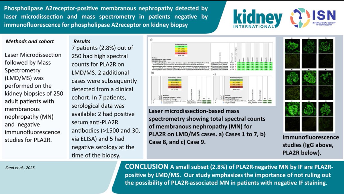 ISN Education (@isneducation) on Twitter photo 9/n #ECNeph <a href="/ISNkidneycare/">Int Society of Nephrology</a> <a href="/myadla/">manjusha yadla</a> <a href="/Dilushiwijay/">Dilushi Wijayaratne</a> <a href="/shubharthikar/">Shubharthi Kar, MD, FISN</a>
Does PLA2R neg on tissue -IF rule out PMN
Lets check this
LMD/MS of tissue Bx +ve in 3% of PLA2R neg MN by IF
kidney-international.org/article/S0085-… 9/n #ECNeph <a href="/ISNkidneycare/">Int Society of Nephrology</a> <a href="/myadla/">manjusha yadla</a> <a href="/Dilushiwijay/">Dilushi Wijayaratne</a> <a href="/shubharthikar/">Shubharthi Kar, MD, FISN</a>
Does PLA2R neg on tissue -IF rule out PMN
Lets check this
LMD/MS of tissue Bx +ve in 3% of PLA2R neg MN by IF
kidney-international.org/article/S0085-…