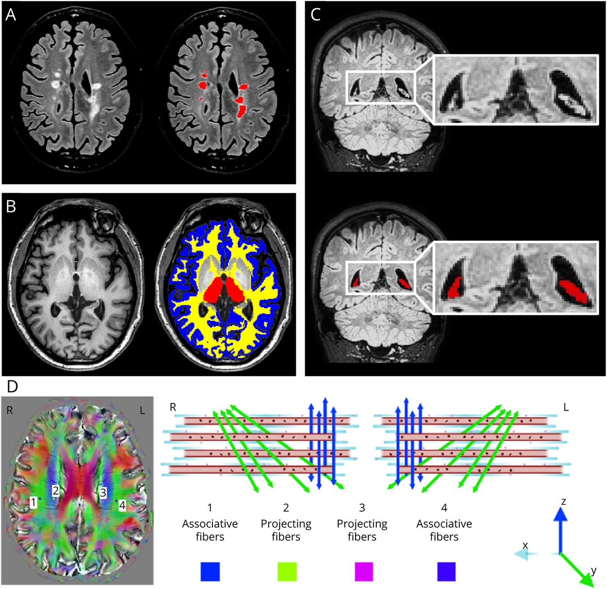 "[E]nlarged [choroid plexus] may contribute to brain damage accumulation, partially through impaired #glymphatic system clearance. If confirmed... processes...could represent novel therapeutic targets for...detrimental effects of #MS on🧠damage&amp; irreversible clinical disability."