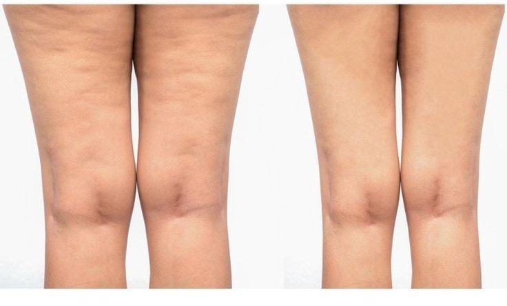 بوريكم كيف تخفون علامات التمدد بالجلد (السيلوليت) اللي تخرب منظر جسمك بفترة بسيطة ✨️👌

كود خصم ايهيرب 🌿. 
NLL9977