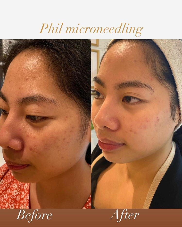 hana_hana1987's tweet image. Transform your skin with Phil Microneedling!  Before and After results show smoother, clearer skin. #Microneedling #SkincareTransformation #PhilMicroneedling