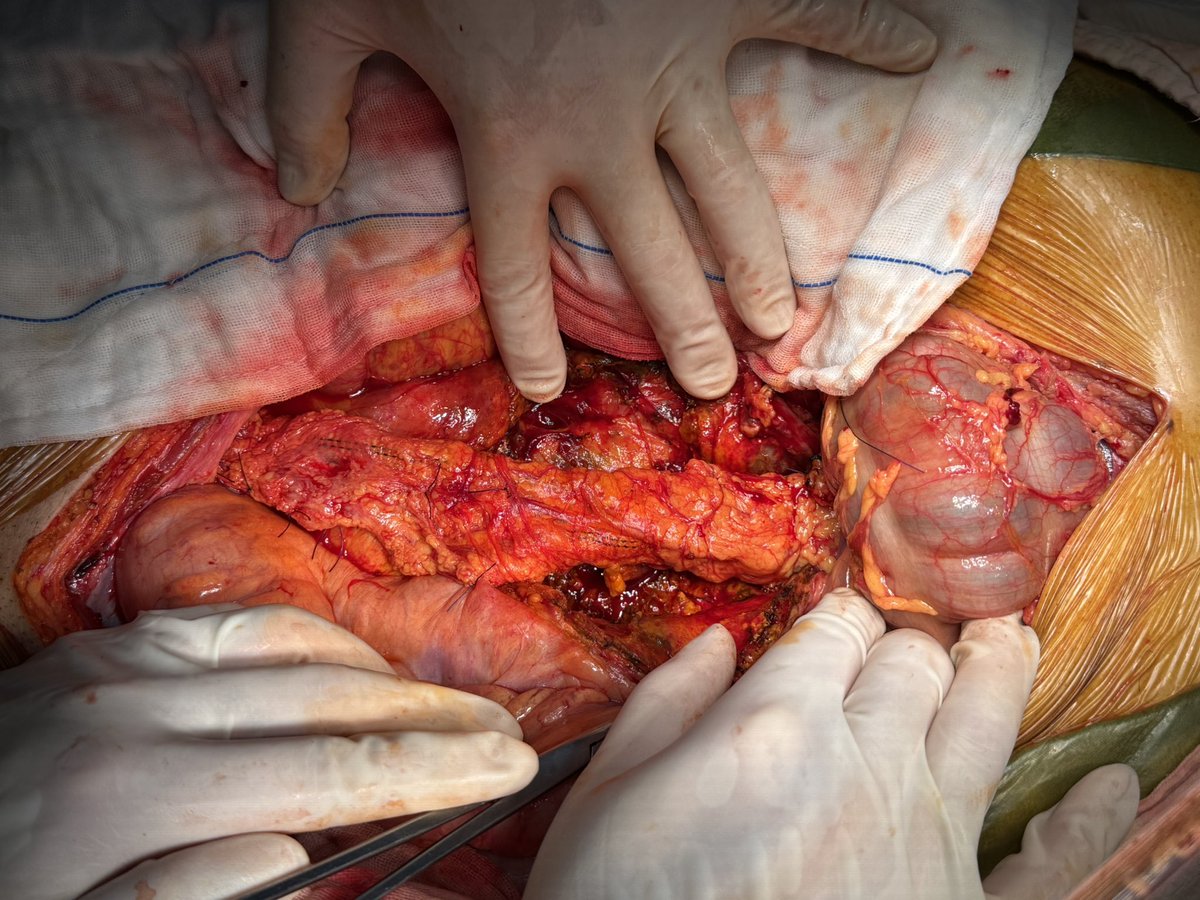 Every case of infected abdominal aortic aneurysm is never a battle fought by the vascular surgery department alone. It requires close collaboration from the departments of infectious diseases, pharmacy, anesthesia, blood bank, retroperitoneal surgery, intensive care unit,