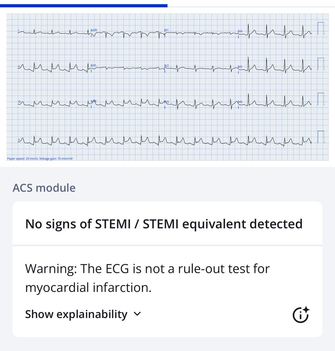 <a href="/AMigelheva/">Asanka Migelheva</a> <a href="/ECGcases/">Jesse McLaren</a> <a href="/smithECGBlog/">Stephen W. Smith</a> <a href="/amalmattu/">Amal Mattu</a> <a href="/RobertHermanMD/">Robert Herman, MD, PhD</a> Queens opinion: