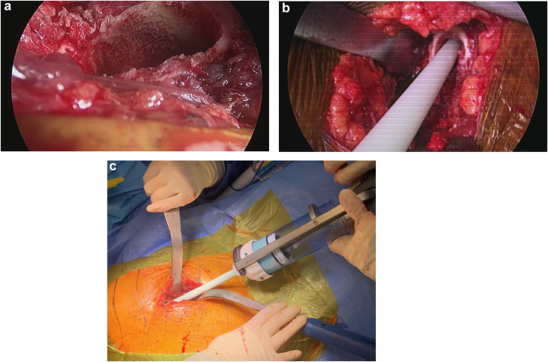 Arthroplasty Today (@arthrotoday) on Twitter photo SURGICAL TECHNIQUE:
No trial necessary?
Bezwada et al. report their broach-to-cement technique for DAA hemiarthroplasty in fracture patients. Would you cement without trialing? <a href="/yoon_rs/">Richard S. Yoon, MD</a> <a href="/bethgausdenmd/">Elizabeth Gausden</a> <a href="/CourtneyBellMD/">Courtney Bell MD</a>
arthroplastytoday.org/article/S2352-… SURGICAL TECHNIQUE:
No trial necessary?
Bezwada et al. report their broach-to-cement technique for DAA hemiarthroplasty in fracture patients. Would you cement without trialing? <a href="/yoon_rs/">Richard S. Yoon, MD</a> <a href="/bethgausdenmd/">Elizabeth Gausden</a> <a href="/CourtneyBellMD/">Courtney Bell MD</a>
arthroplastytoday.org/article/S2352-…