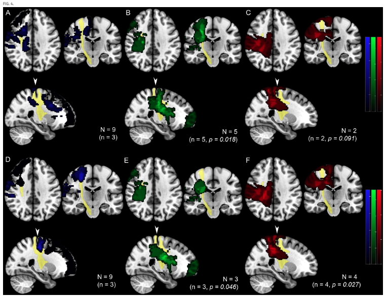 #FreeArticle. Researchers investigate peri-rolandic epilepsy cases managed with resective surgery and highlight factors responsible for postoperative seizure outcomes and motor deterioration. 

thejns.org/view/journals/…