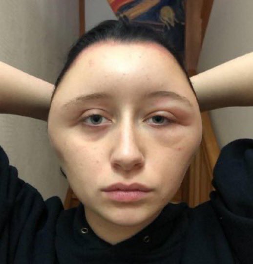 porqueTTarg's tweet photo. "Cabeza"

Por cómo se le puso ma cabeza a esta chica ante una reacción alérgica a un producto para teñirse el pelo. https://t.co/ORT0ehrL5J