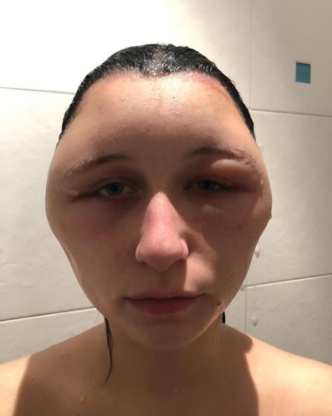 porqueTTarg's tweet photo. "Cabeza"

Por cómo se le puso ma cabeza a esta chica ante una reacción alérgica a un producto para teñirse el pelo. https://t.co/ORT0ehrL5J