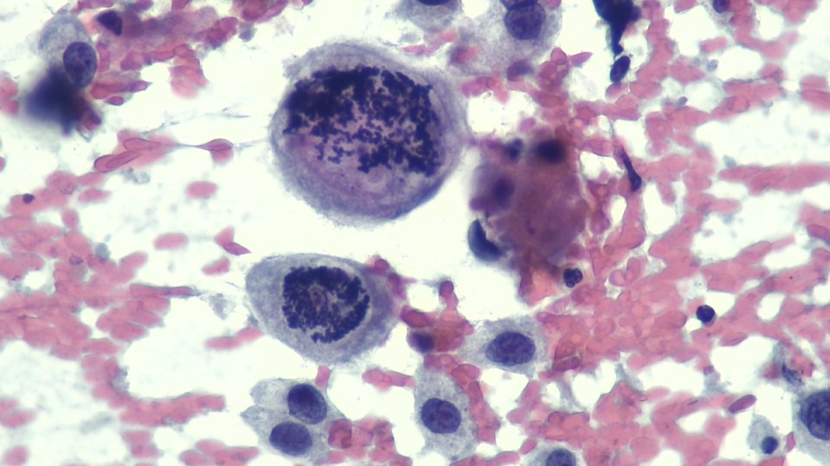 mdlozanoe's tweet photo. Poorly differentiated/anaplastic PDAC. Very threatening, huge, and ugly cells. EUS-FNA pancreas ๐ฑ๐จ๐ซฃ @IACytology @EfcsYoung @SEAP_IAP @SECitologia @ESP_Pathology @cytopathology @mtsiddi @MauroSaieg @maperezmachado @MozeticV @MerceJorda1 @Sinchita_Roy #ProudMIAC https://t.co/IFspXrth8P