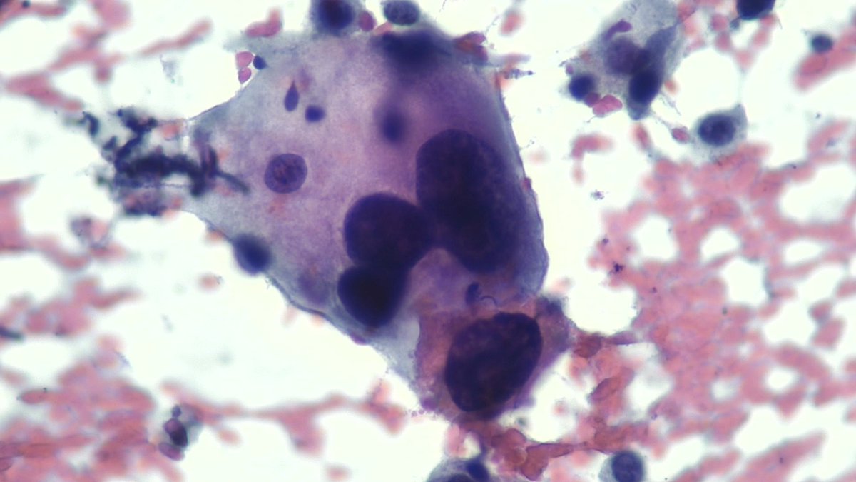 mdlozanoe's tweet photo. Poorly differentiated/anaplastic PDAC. Very threatening, huge, and ugly cells. EUS-FNA pancreas ๐ฑ๐จ๐ซฃ @IACytology @EfcsYoung @SEAP_IAP @SECitologia @ESP_Pathology @cytopathology @mtsiddi @MauroSaieg @maperezmachado @MozeticV @MerceJorda1 @Sinchita_Roy #ProudMIAC https://t.co/IFspXrth8P