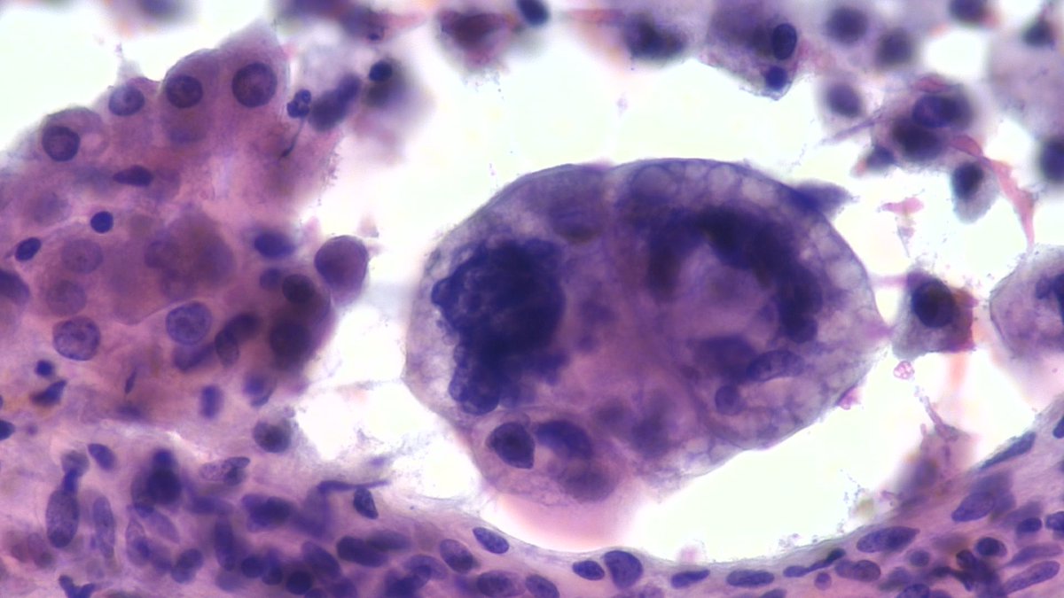 mdlozanoe's tweet photo. Poorly differentiated/anaplastic PDAC. Very threatening, huge, and ugly cells. EUS-FNA pancreas ๐ฑ๐จ๐ซฃ @IACytology @EfcsYoung @SEAP_IAP @SECitologia @ESP_Pathology @cytopathology @mtsiddi @MauroSaieg @maperezmachado @MozeticV @MerceJorda1 @Sinchita_Roy #ProudMIAC https://t.co/IFspXrth8P