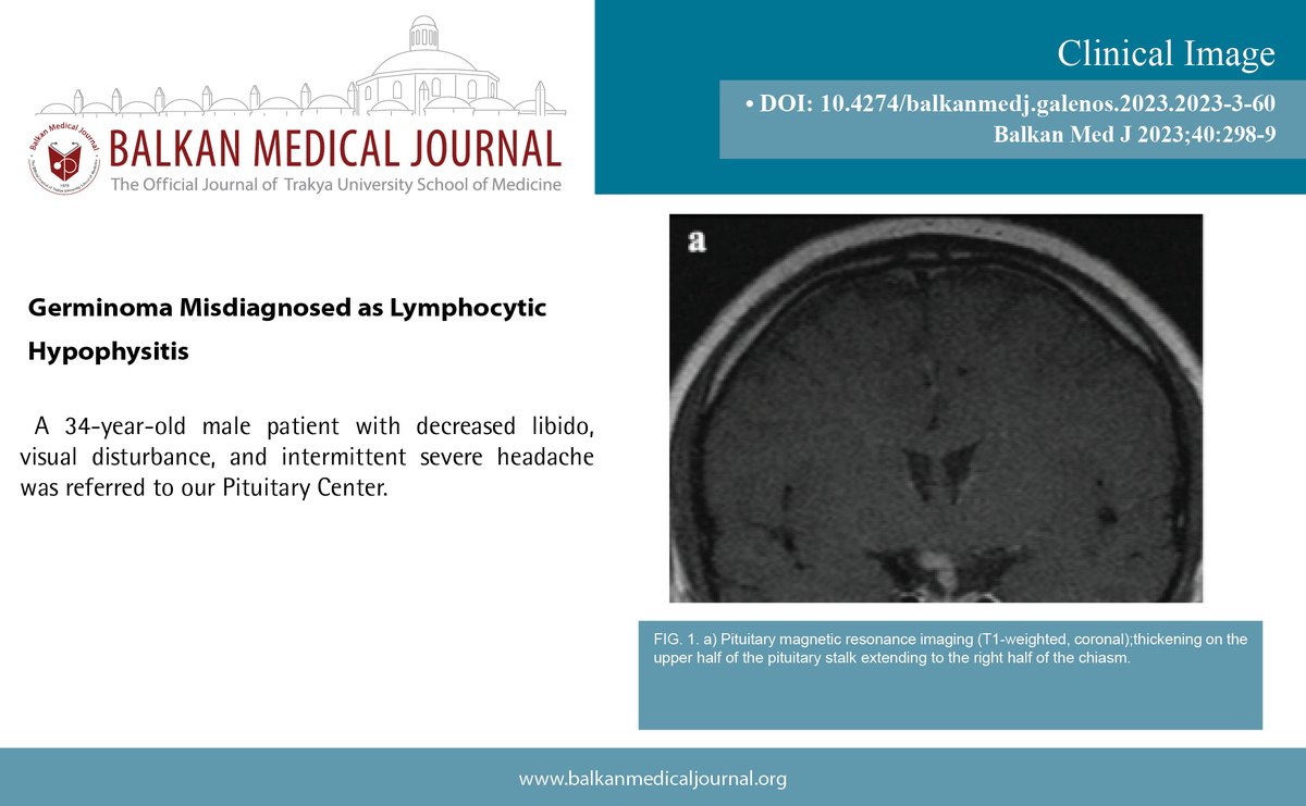 Germinoma Misdiagnosed as Lymphocytic Hypophysitis

You can see the free full text of the research by Serdar Şahin et al.

Link : balkanmedicaljournal.org/uploads/pdf/pd…