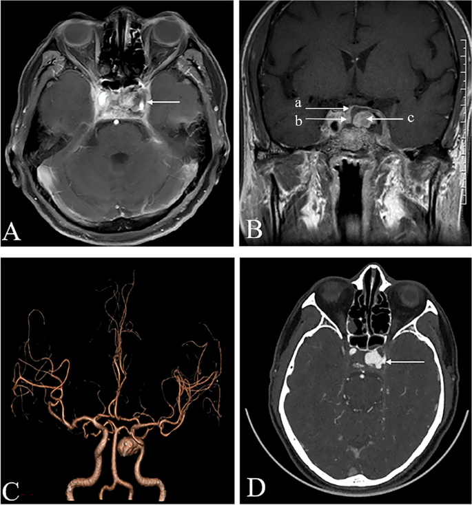 NeuroimagingDB's tweet photo. Infectious cavernous sinus thrombosis
✅副鼻腔炎、中耳炎、歯科感染から波及
✅隣接するICAに動脈瘤を形成する
✅ここに動脈瘤を見たら海綿静脈洞や眼静脈への血栓性静脈炎の有無を確認
PMID: 36647050 https://t.co/7UpyP6OxBq