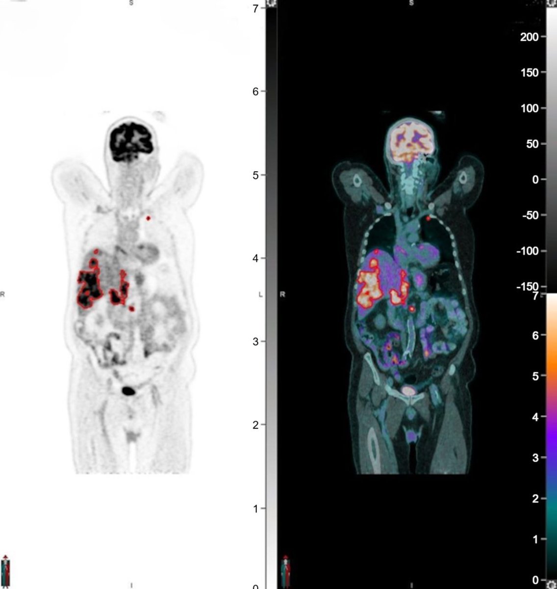 Metabolic tumor volume on ¹⁸F-FDG PET is a prognostic biomarker in patients with advanced gastroenteropancreatic neuroendocrine neoplasm. ow.ly/zz4K50W1Al8
#NuclearMedicine #PETscan #NeuroendocrineTumor