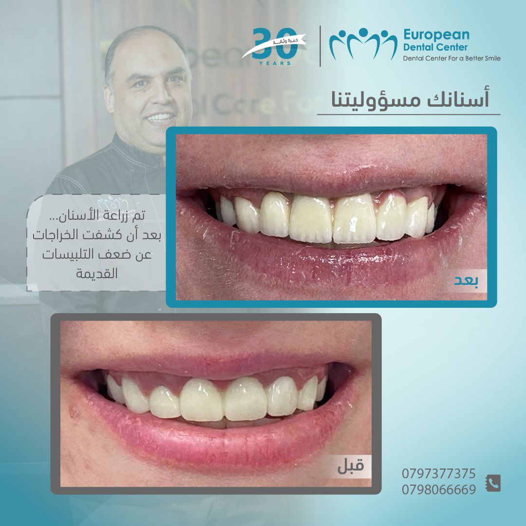 خيارنا كان زراعة الأسنان... بعد أن كشفت الخراجات عن ضعف التلبيسات القديمة

تختلف الإجراءات الطبية وفقًا لكل حالة مريض، ويعتمد اتخاذ القرار المناسب لتجميل أسنانك للطبيب المعالج لحالتك 

يقرر الدكتور مهند الكسواني في المركز الأوروبي لطب الأسنان ما يناسبك وفق حالة أسنانك.

هل أنت