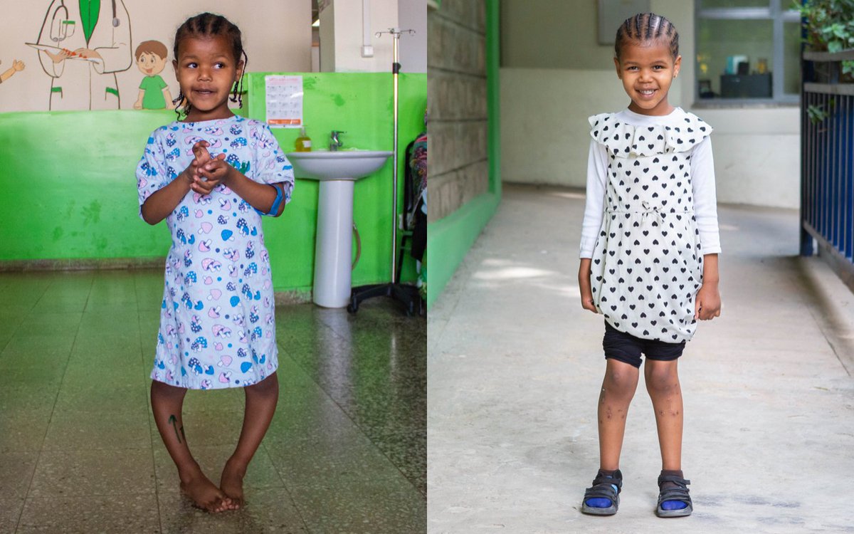 #ServicesWeProvide
#BowedLegSurgery
Bowed legs is a condition where the legs bend outwards around or below the knees, even when the ankles are together.
To learn more about CURE Children's Hospital of Ethiopia and the services we provide, please visit ethiopia.cure.org.
