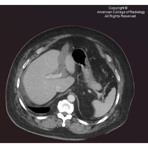 A 70-year-old man presents with a 1-day history of abdominal pain, bloating, nausea without vomiting, and nonbloody diarrhea. #ACRCaseinPoint bit.ly/3HvwAYQ
