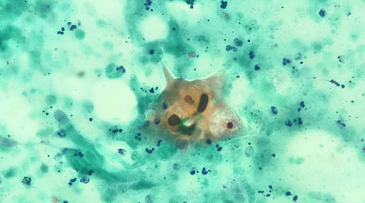 #dyskeratosis
#metastasis
Dyskeratotic cell in a necrotic background 
#PathTwitter 
#cytopath