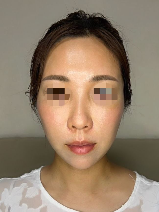 ex_3jsbaka's tweet photo. 韓国のジャスト美容整形外科で、目の下脂肪再配置再手術、目の下・前頬脂肪移植、ピーチシルエット、トリプルエッグリフト、ほうれい線フィラー、横頬フィラー、こめかみフィラーを受けてきました💉執刀医はピョ院長です✨
2週間たって、だいぶ腫れもひいてきました😊今後の経過が楽しみ💓
＠justprsjp https://t.co/RYGev7U18K