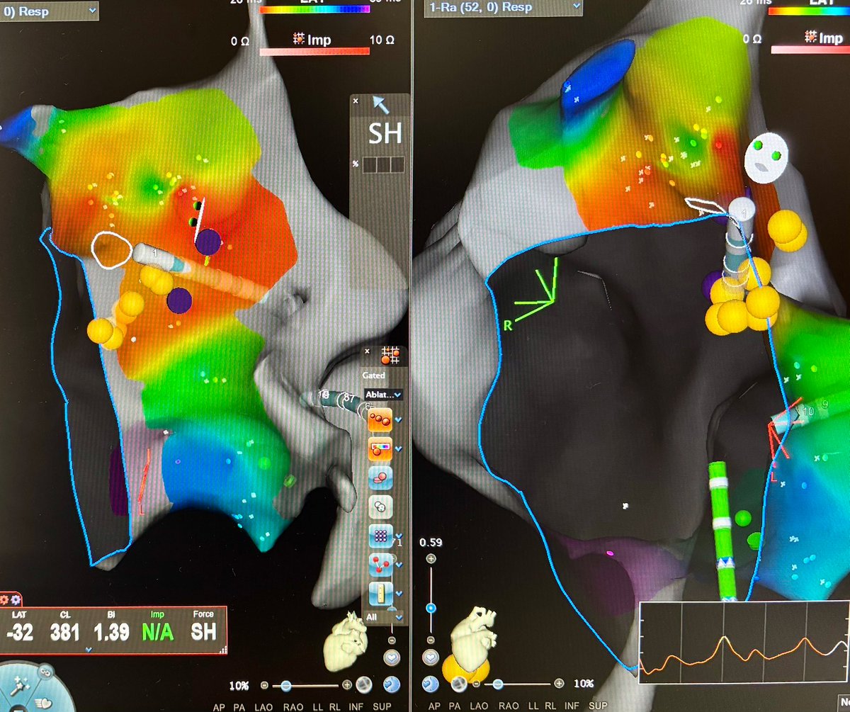 Very nice cases: scar related RA reentrant tachycardia by Dr. Mendoza and perihisian AP by Dr. Medina in Dr. Negrin Hospital in Gran Canaria. Thank you for the welcome and all the support of Dr. Caballero and the rest of the team! #ePeeps #cardiology <a href="/ArritmiasNegrin/">Arritmias Hospital Dr. Negrín ⚡</a>