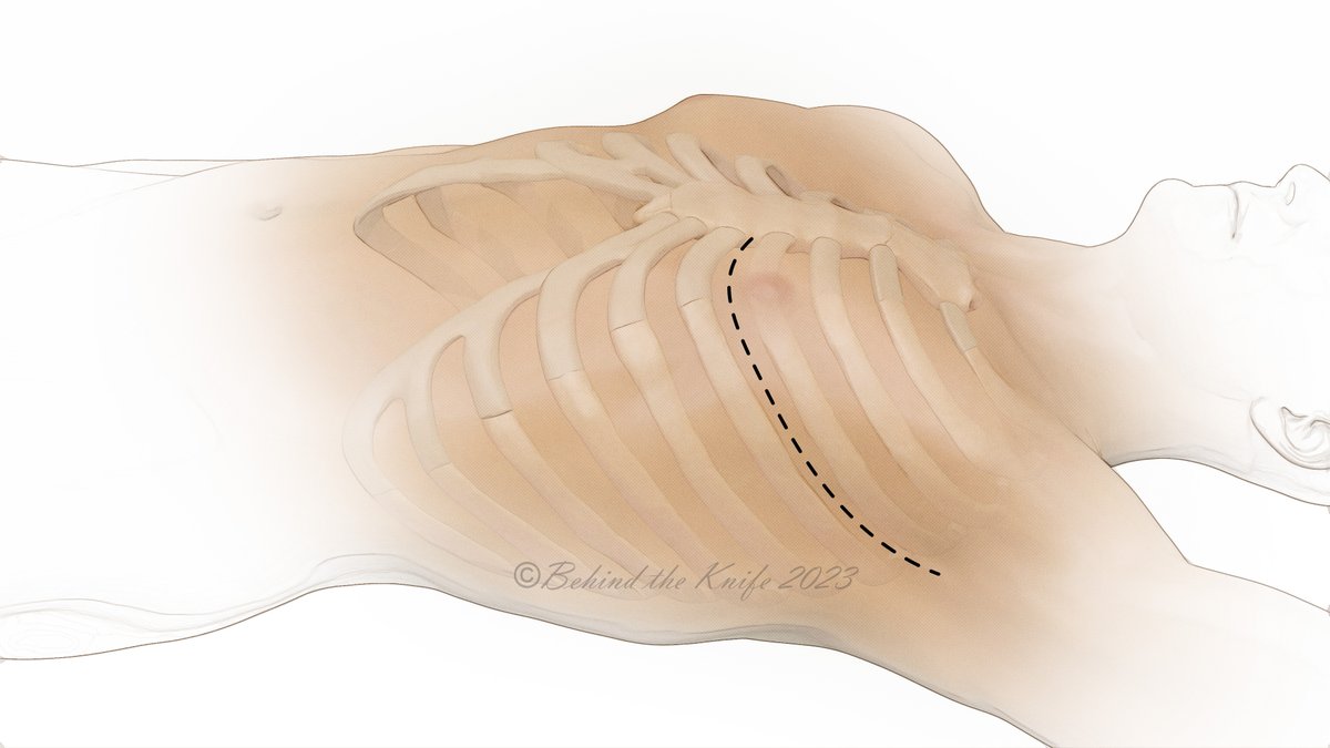 Patrick Georgoff, MD (@georgoff) on Twitter photo The resuscitative thoracotomy is a procedure unlike any other. Are you prepared to make a split-second decision⏱️??
Review <a href="/WesternTrauma/">WesternTrauma</a> adult guidelines ➡️the new gold 🪙standard: pubmed.ncbi.nlm.nih.gov/39451159/
Deep breath...
✔️ Big problems require big incisions ➡️ edge of sternum The resuscitative thoracotomy is a procedure unlike any other. Are you prepared to make a split-second decision⏱️??
Review <a href="/WesternTrauma/">WesternTrauma</a> adult guidelines ➡️the new gold 🪙standard: pubmed.ncbi.nlm.nih.gov/39451159/
Deep breath...
✔️ Big problems require big incisions ➡️ edge of sternum