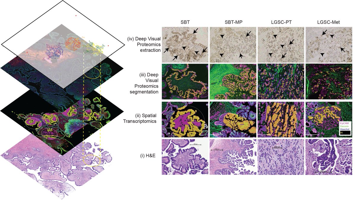 OvCa_UChicago's tweet image. New from the Lengyel/Kenny Lab: our study in @Cancer_Cell with @labs_mann charts how borderline ovarian tumors evolve into low-grade serous ovarian cancer, using spatial proteo-transcriptomics to uncover molecular drivers & potential therapeutic targets.
sciencedirect.com/science/articl…