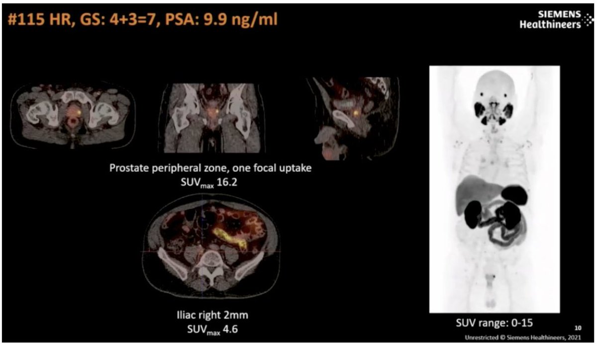 UroToday.com (@urotoday) on Twitter photo First data of a novel PSMA-targeting radiopharmaceutical compound SMS-5368: Exploratory and phase 1/2 results. Presentation by Paul Hatcher, MD <a href="/utmedicalcenter/">utmedicalcenter</a>. #SNMMI25 written coverage by <a href="/RKSayyid/">Rashid K. Sayyid</a> <a href="/USC/">USC</a> > bit.ly/3TNg8WM <a href="/SNM_MI/">SNMMI</a> #SNMMI2025 First data of a novel PSMA-targeting radiopharmaceutical compound SMS-5368: Exploratory and phase 1/2 results. Presentation by Paul Hatcher, MD <a href="/utmedicalcenter/">utmedicalcenter</a>. #SNMMI25 written coverage by <a href="/RKSayyid/">Rashid K. Sayyid</a> <a href="/USC/">USC</a> > bit.ly/3TNg8WM <a href="/SNM_MI/">SNMMI</a> #SNMMI2025
