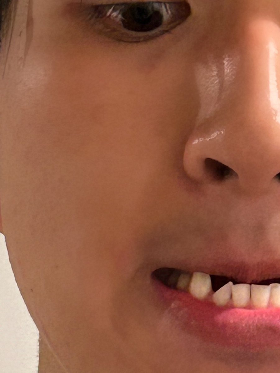 vsアストロノーツでした。
悔しいことだらけ。

思いっきり殴ったり蹴ったりしたら、何倍にもなって帰ってきました。
ただでさえ、すきっ歯なのに歯が欠けて更にすきっ歯になってしまった。

でもこれが僕が興奮してきたものだし、やりたかったことの１つができて超楽しかった。
#bjw
#bjw北海道ツアー