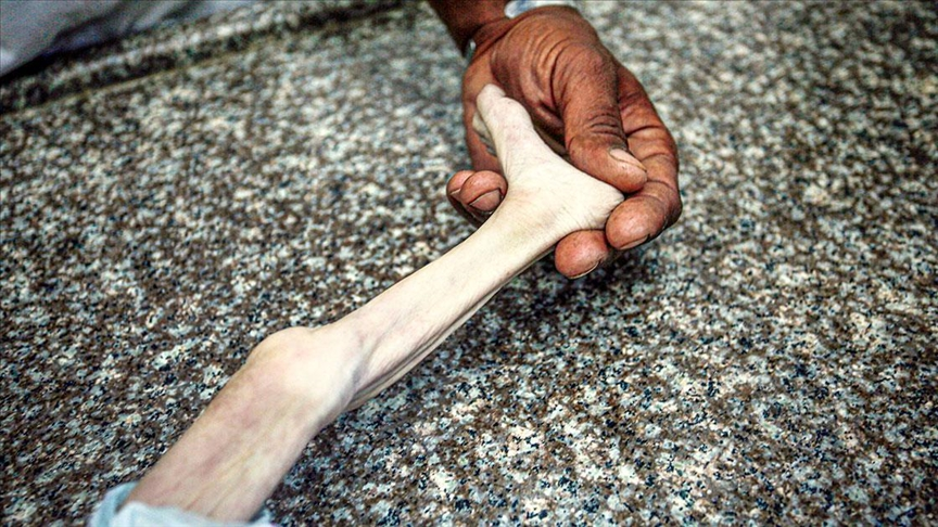 🔴 Gazze'de bir bebek daha yetersiz beslenme sebebiyle şehit oldu.