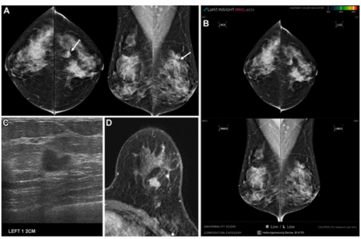 Diagnostic Imaging (@dx_imaging) on Twitter photo New Study Examines Key Factors with False Negatives on #AI #Mammography Analysis
diagnosticimaging.com/view/new-study…
<a href="/RadiologyACR/">American College of Radiology</a> <a href="/ARRS_Radiology/">ARRS</a> <a href="/RSNA/">RSNA</a> <a href="/JBI_SBI/">Journal of Breast Imaging</a> <a href="/BreastImaging/">Society of Breast Imaging</a> <a href="/DukeRadiology/">Duke Radiology</a> <a href="/MontefioreRAD/">Montefiore Radiology</a> <a href="/OSURadiology/">Ohio State Radiology</a> <a href="/JeffersonRads/">Jefferson Radiology</a> <a href="/UNCRadiology/">UNC Radiology</a> <a href="/BrighamRad/">Brigham and Women's Radiology</a>
#radiology #RadRes New Study Examines Key Factors with False Negatives on #AI #Mammography Analysis
diagnosticimaging.com/view/new-study…
<a href="/RadiologyACR/">American College of Radiology</a> <a href="/ARRS_Radiology/">ARRS</a> <a href="/RSNA/">RSNA</a> <a href="/JBI_SBI/">Journal of Breast Imaging</a> <a href="/BreastImaging/">Society of Breast Imaging</a> <a href="/DukeRadiology/">Duke Radiology</a> <a href="/MontefioreRAD/">Montefiore Radiology</a> <a href="/OSURadiology/">Ohio State Radiology</a> <a href="/JeffersonRads/">Jefferson Radiology</a> <a href="/UNCRadiology/">UNC Radiology</a> <a href="/BrighamRad/">Brigham and Women's Radiology</a>
#radiology #RadRes