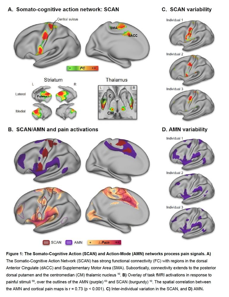 Figure 1 (attached) shows how these networks:  

• Interdigitate with traditional motor areas 
• Align closely with pain activations (r=0.73) 
• Vary dramatically between individuals  

These are non-sensory pain networks. 
That’s why classic targeting misses.
