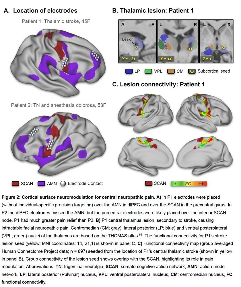 So, we examined it in our prior cortical stimulation patients.   

Two patients with central neuropathic pain.  
* One had electrodes over both SCAN &amp; AMN. 
*One hit only SCAN.  

Pain relief tracked exactly with network engagement. Precision matters!!!!