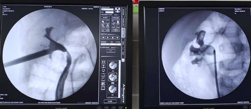 We had a 1-year and 10-day-old baby with bilateral renal stones.
We attempted RIRS, though  the access sheath could be inserted upto mid ureter , the outflow was not there .
RGP showed a large stone burden. Supine PCNL was performed through the middle calyx, and all stones were