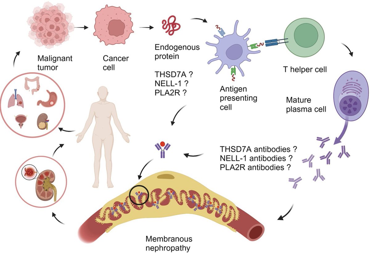 How does malignancy cause MN 
 #ECNeph  <a href="/myadla/">manjusha yadla</a> <a href="/Dilushiwijay/">Dilushi Wijayaratne</a> <a href="/ISNkidneycare/">Int Society of Nephrology</a>  frontiersin.org/journals/medic…