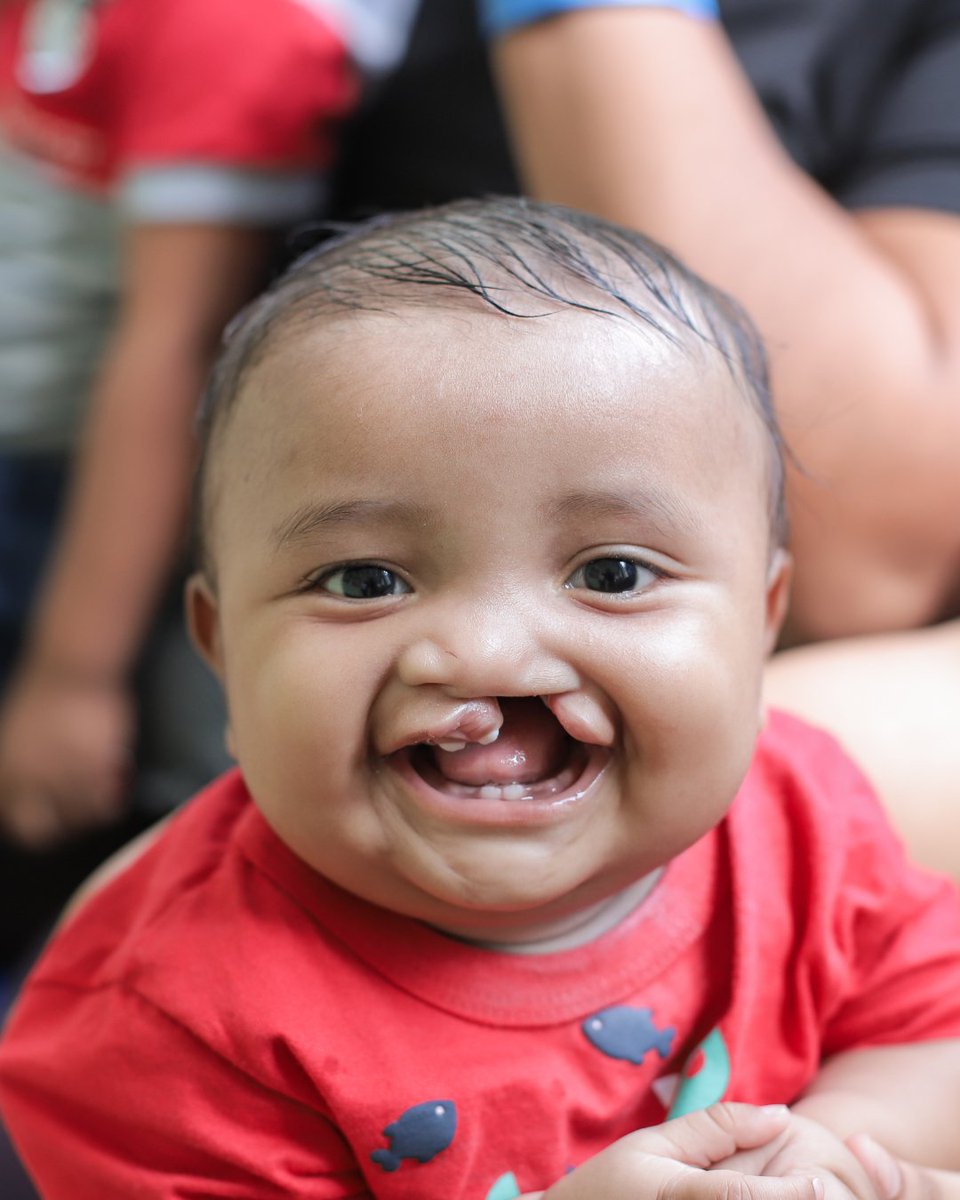 Smile Train UK (@smiletrainuk) on Twitter photo Since 2001, we've helped over 51,000 cleft-affected children receive comprehensive, non-surgical cleft care across Brazil. 🇧🇷
Through your generous support, children like Dia can live a full and healthy life. Since 2001, we've helped over 51,000 cleft-affected children receive comprehensive, non-surgical cleft care across Brazil. 🇧🇷
Through your generous support, children like Dia can live a full and healthy life.