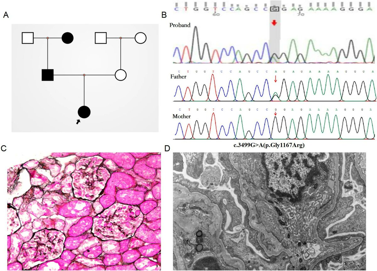 Alport syndrome (AS) is a hereditary glomerular disease in children characterized by hematuria, proteinuria, &amp; progressive kidney failure. Read these Clinical Insights into a child w/autosomal dominant AS complicated w/steroid-sensitive nephrotic syndrome.
link.springer.com/article/10.100…