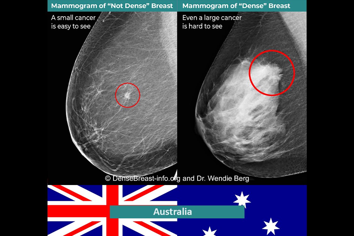 Update from Australia:
Visits to DenseBreast-info.org from "Down Under" are on the rise following BreastScreen Australia's new recommendation to inform women about breast density during routine mammograms.

Read more: health.gov.au/resources/publ…

#BreastDensity  #DenseBreast