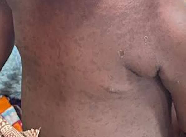 A measles outbreak has claimed the lives of two infants in Alito Sub-county, Kole District, while seven other children remain in critical condition.

The incident has raised the attention of health authorities, who have swiftly responded and are working around the clock to