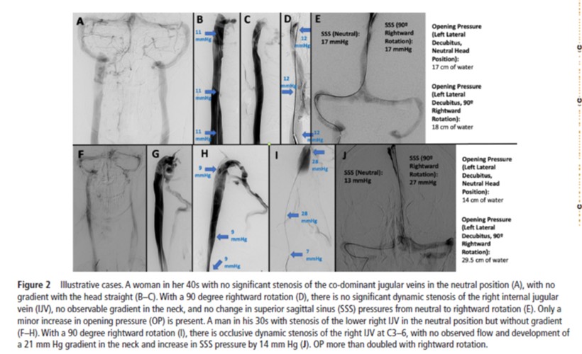 Do you know what you are measuring?  Dynamic head rotation can dramatically alter intracranial venous pressure measurements, indicating single position lumbar puncture opening pressure may not tell the whole story! bit.ly/4l7y4Hr #ICP #JugularStenosis