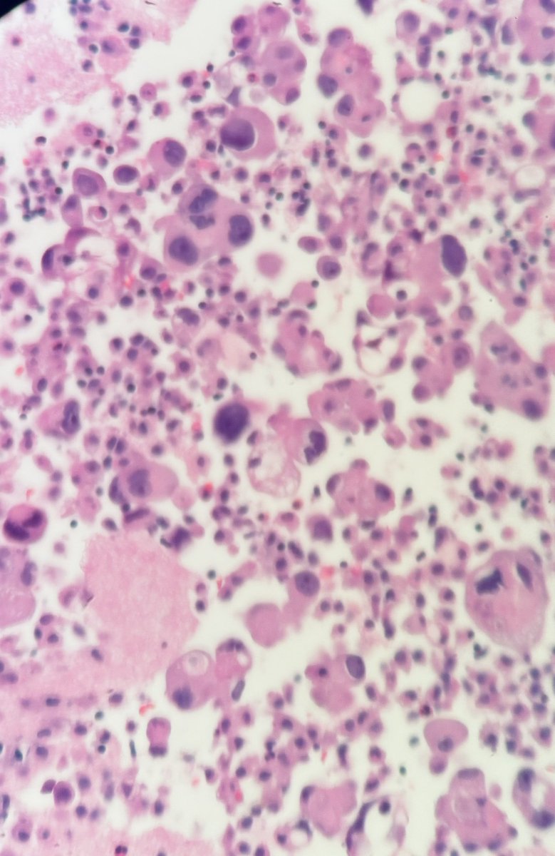 Generous cell block good for molecular testing #cytology