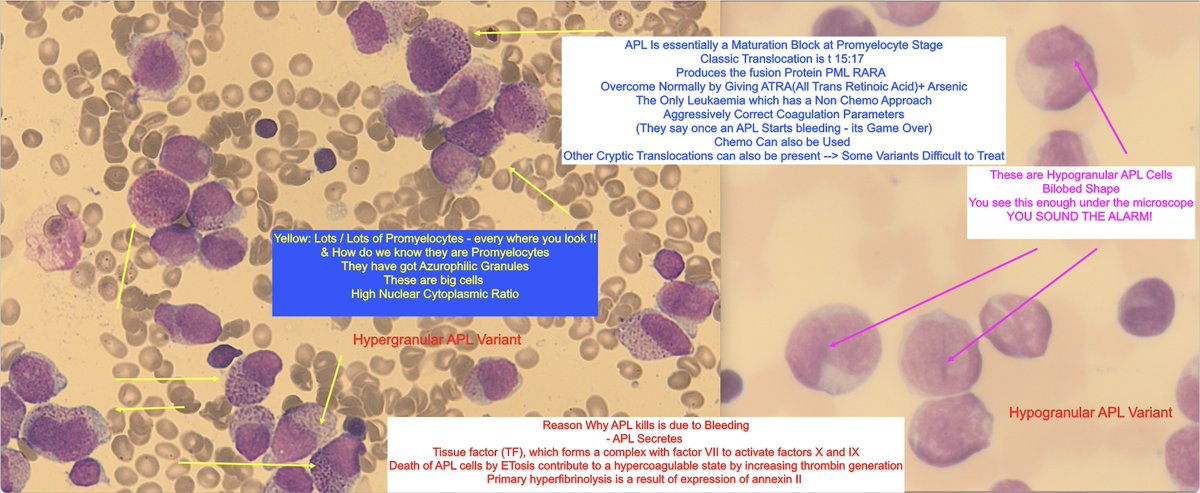 Recently had a Young APL
I figured a "Morphological Refresher" would serve the greater good
Just Remember
🚨Act Early / Treat Coagulopathy / Start ATRA 
🚨If an APL starts Bleeding the boat has most likely sailed⛵️
#hematology #medtwitter #meded #Medicine