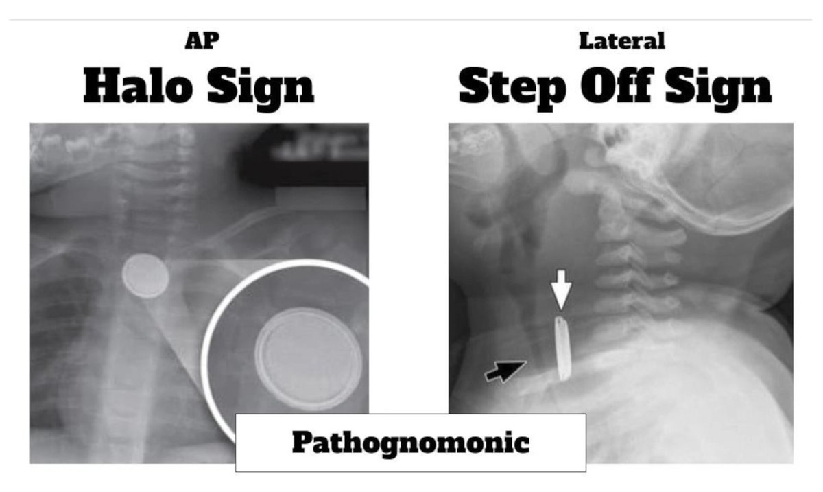 EMCases's tweet image. New EM Quick Hit VIDEO!
Recognition/Management Button Battery Ingestion
How to pick up this oft elusive Dx before esophageal necrosis/rupture ensues...
With Olivia Ostrow
emergencymedicinecases.com/video/em-quick…
#FOAMed
#pediatricEM