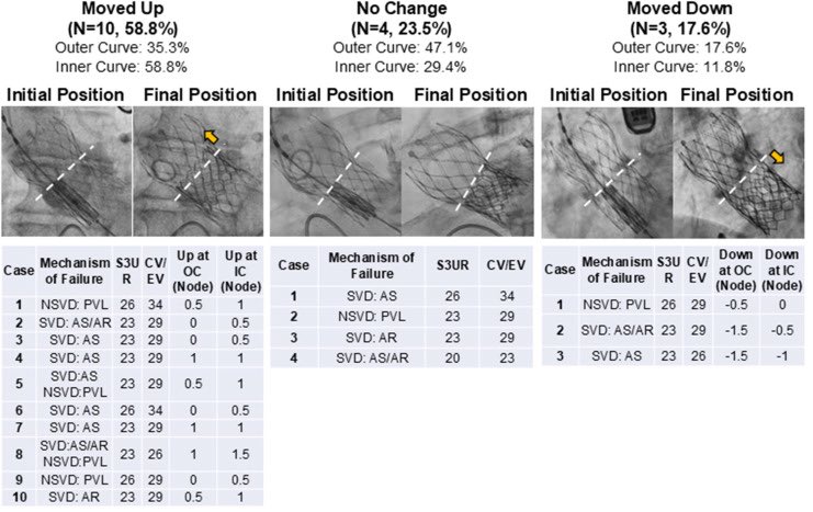 Dr. Gilbert Tang (@gilberttangmd) on Twitter photo JUST OUT sim pub #JACCINT #NYValves2025 <a href="/JACCJournals/">JACC Journals</a> our Short-in-Tall redo-TAVR fluoro analysis showing unpredictable movement of Sapien 3 in Evolut. Congrats to our fellow Takayuki Onishi <a href="/ParasuramMD/">Parasuram Krishnamoorthy MD</a> <a href="/KHERA_MD/">Sahil Khera</a> <a href="/LucySafi/">Lucy</a> <a href="/DoctorKini/">DoctorKini</a> for this FIH report
jacc.org/doi/10.1016/j.… JUST OUT sim pub #JACCINT #NYValves2025 <a href="/JACCJournals/">JACC Journals</a> our Short-in-Tall redo-TAVR fluoro analysis showing unpredictable movement of Sapien 3 in Evolut. Congrats to our fellow Takayuki Onishi <a href="/ParasuramMD/">Parasuram Krishnamoorthy MD</a> <a href="/KHERA_MD/">Sahil Khera</a> <a href="/LucySafi/">Lucy</a> <a href="/DoctorKini/">DoctorKini</a> for this FIH report
jacc.org/doi/10.1016/j.…