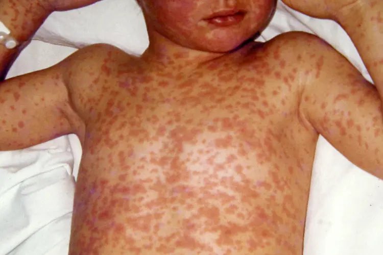 JUST IN: California has already reported more measles cases this year than in all of 2024. The U.S. is facing its worst outbreak in decades, per the LA Times. 

Great job, MAGA.