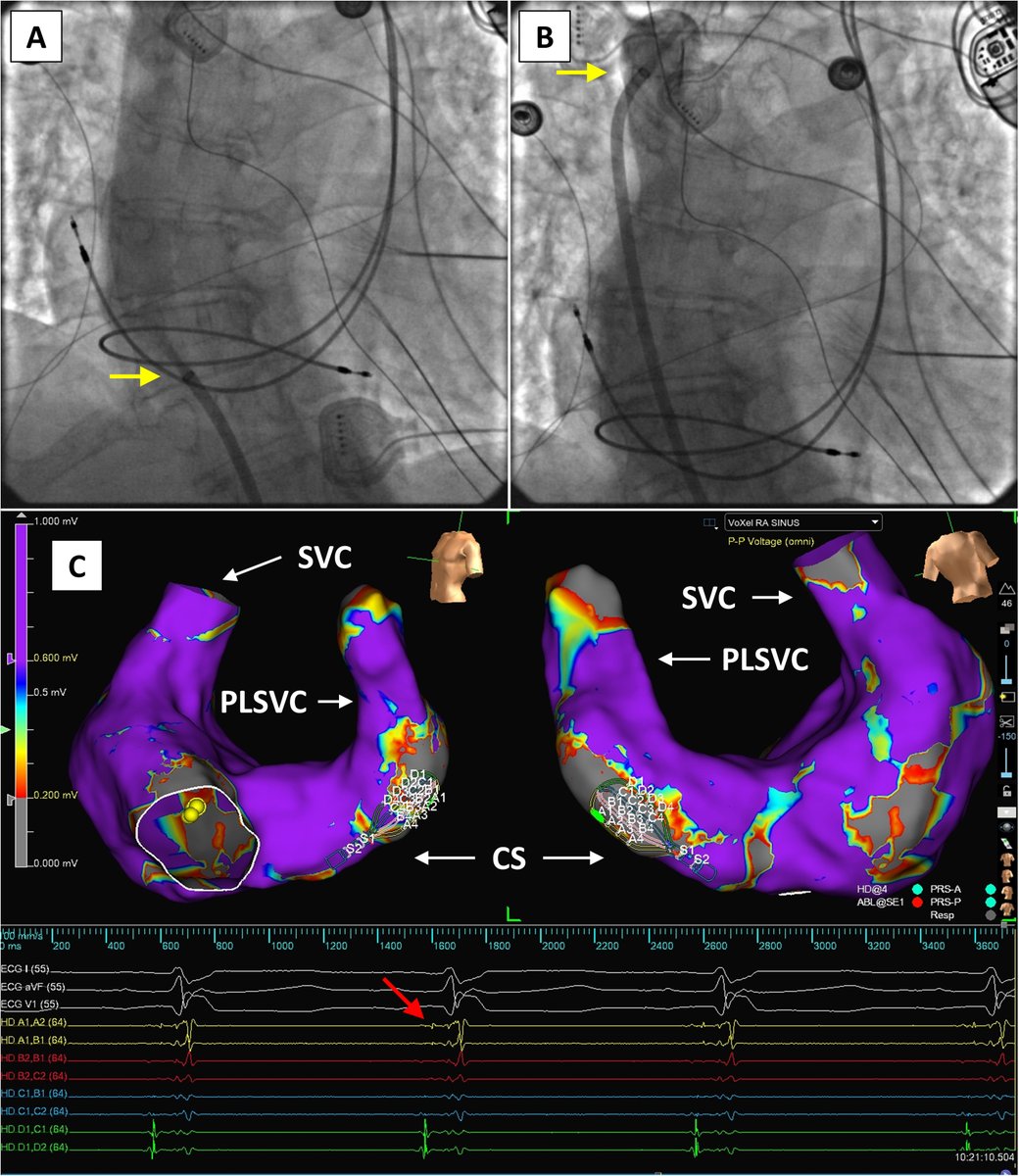 Pulsed field ablation in persistent left superior vena cava for atrial fibrillation via interrupted inferior vena cava with azygos continuation utilizing novel electroanatomic mapping features in the presence of a permanent pacemaker 
<a href="/norman_c_wang/">Norman C. Wang, MD, MS</a> 
heartrhythmcasereports.com/article/S2214-…