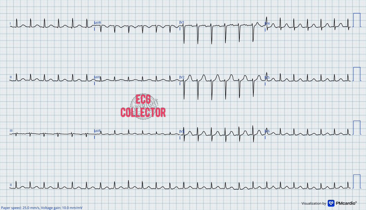 Dr Razi (@drrazi4) on Twitter photo Lady in 50s; HTN, sudden onset of palpitation; BP 132/90mmHg;
What is likely #ecg diagnosis🤔❓
<a href="/PMcardioApp/">PMcardio—AI that reads ECGs</a>
#Cardiology
#cardiotwitter
#Medtwitter
#Medicalstudent Lady in 50s; HTN, sudden onset of palpitation; BP 132/90mmHg;
What is likely #ecg diagnosis🤔❓
<a href="/PMcardioApp/">PMcardio—AI that reads ECGs</a>
#Cardiology
#cardiotwitter
#Medtwitter
#Medicalstudent