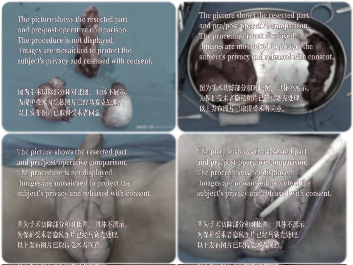 The picture shows the resected part and pre/post-operative comparison. The procedure is not displayed. Images are mosaicked to protect the subject's privacy and released with consent.图为手术切除部分和对比图。
为保护受术者隐私图片已经马赛克处理。以上发布图片已取得受术者同意。