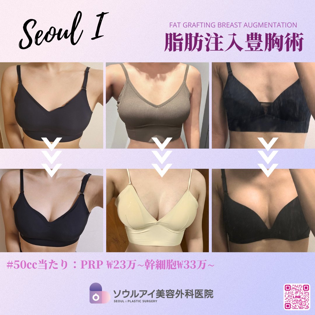 ソウルアイ自慢の脂肪注入豊胸術～！ 手術の病例の写真をご覧ください