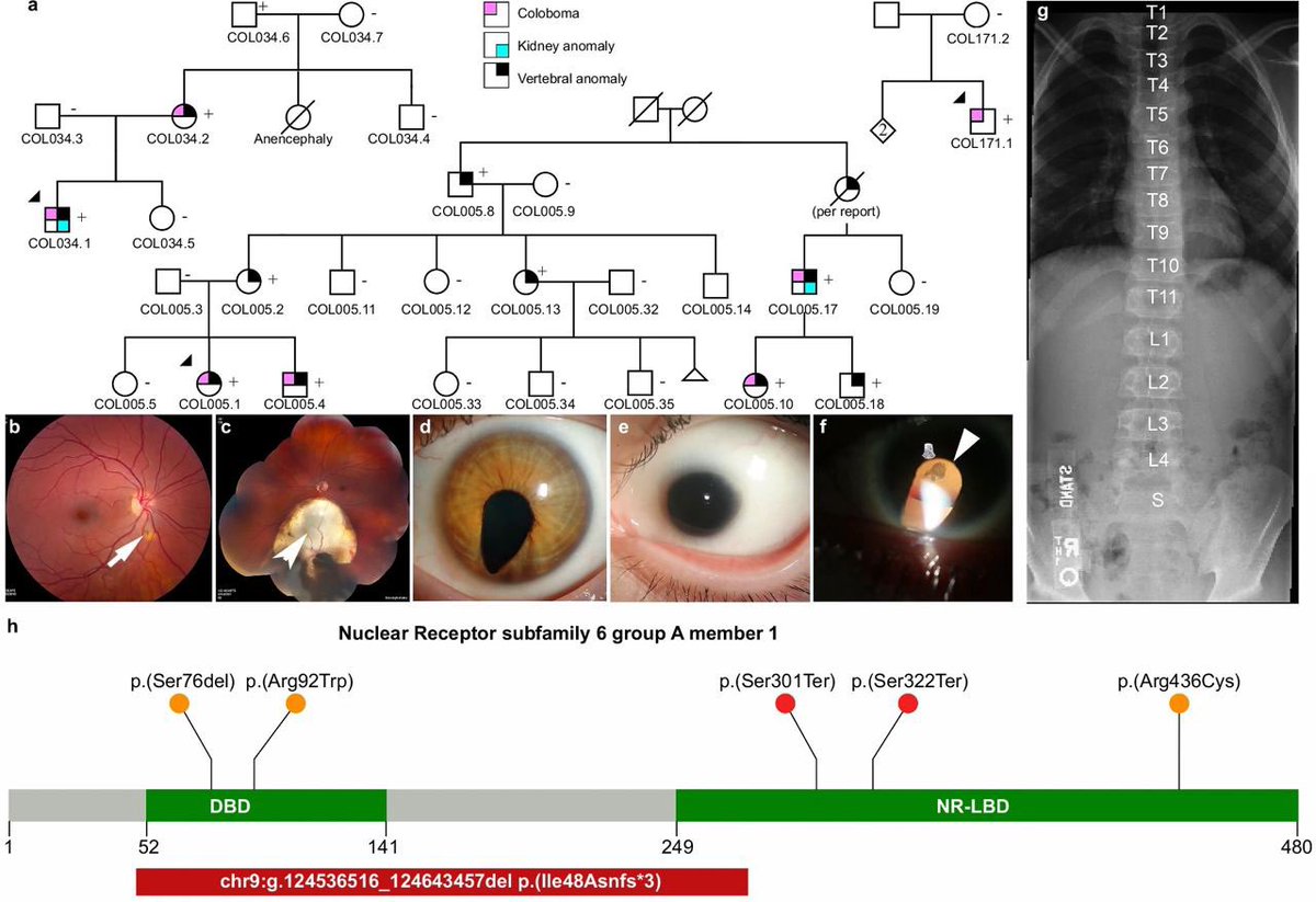 Variants in NR6A1 cause a novel oculo vertebral renal syndrome #RareDisease #Genetics #morbidgene nature.com/articles/s4146…